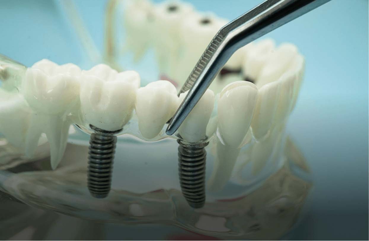 dental-implants-in-Phoenixville