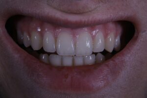 Dental Bonding vs Veneers: Proven Pros and Cons Explained