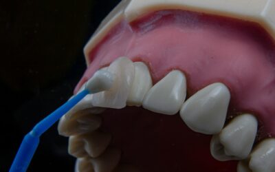 Dental Bonding vs Veneers: Which One Is Right for You?