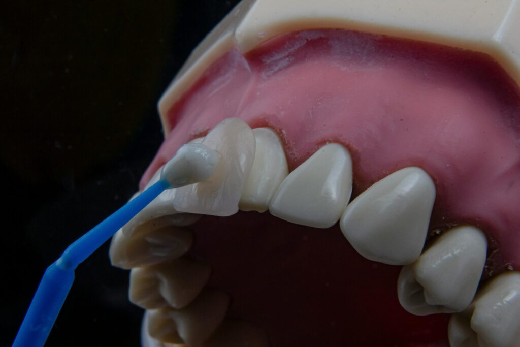 Dental Bonding vs Veneers: Proven Pros and Cons Explained