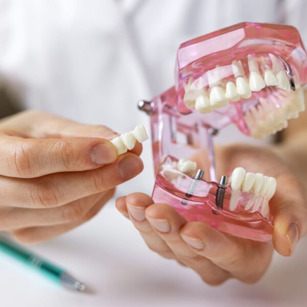 Dental Implants