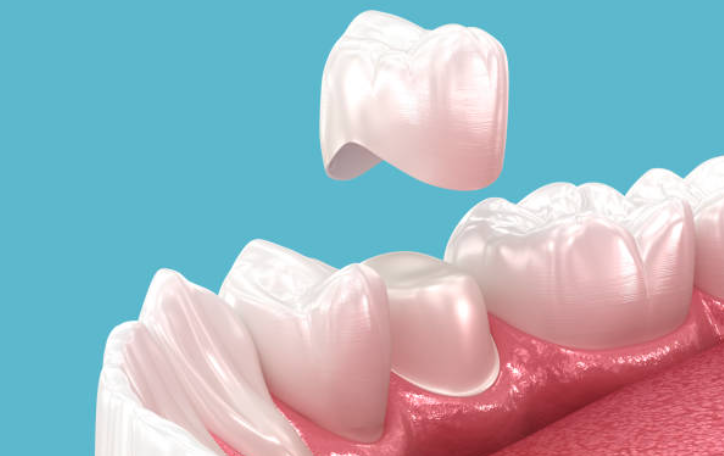 Benefits of dental crowns