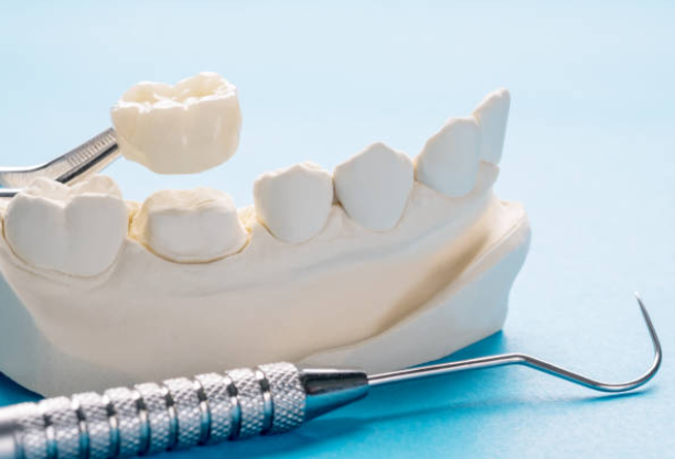 What is dental crowns