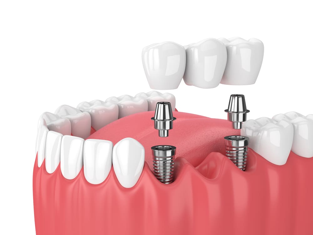 What is a dental bridge