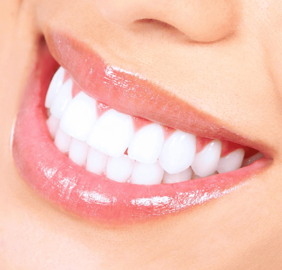 Professional Teeth Whitening