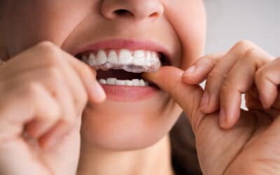 Top 5 Myths About Clear Aligners — Busted by Dentists