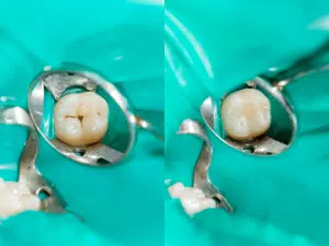 Applying Fluoride sealant on teeth
