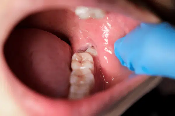 Applying Fluoride sealant on teeth
