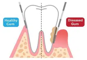 Early Signs of Gum Disease