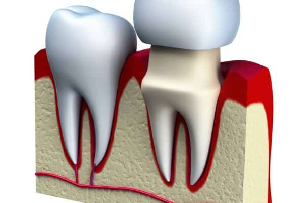 How long do dental crowns last