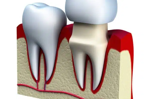 How long do dental crowns last