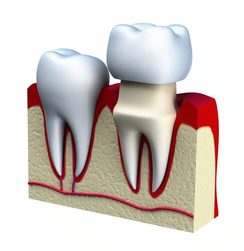 How long do dental crowns last