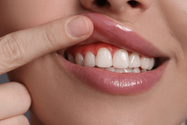 antimicrobial mouthwash for bleeding gums treatment