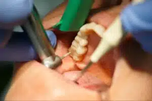 Dental patient getting her molar tooth cavity drilled and fixed at the dentist office.